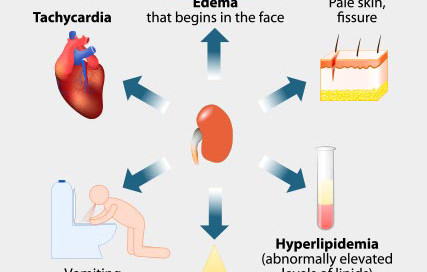 Nephrotic Syndrome