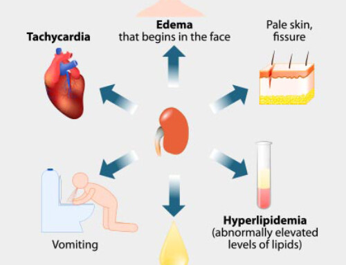 Causes of Nephrotic Syndrome, Evaluation of Nephrotic Proteinuria