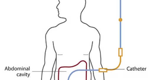 Adequacy of Dialysis