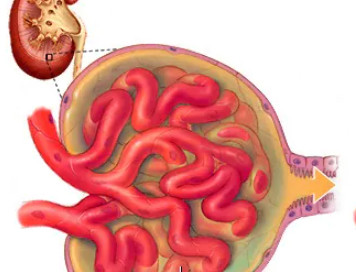 Focal Segmental Glomerulosclerosis