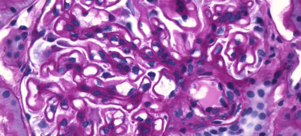 Membranous Nephropathy
