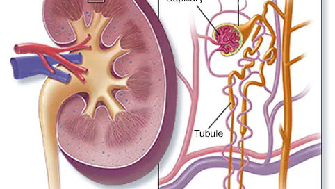IgA Nephropathy