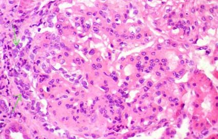 Membranoproliferative Glomerulonephritis