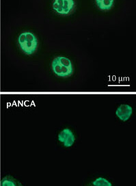 ANCA Associated Glomerulonephritis