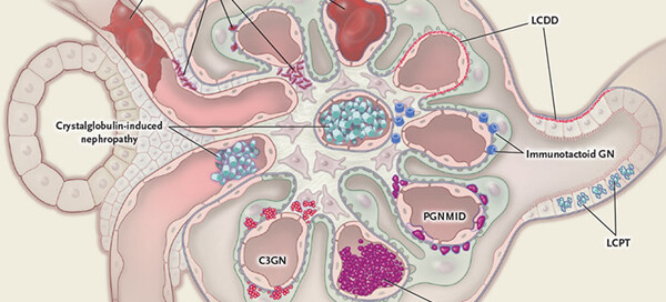 Monoclonal Gammopathy of Renal Significance