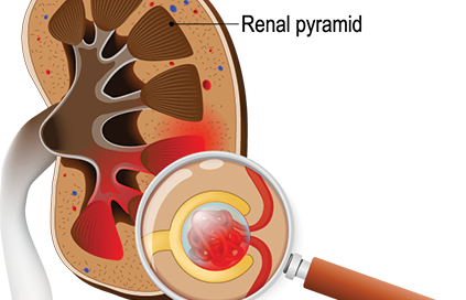 Infection Associated Glomerulonephritis
