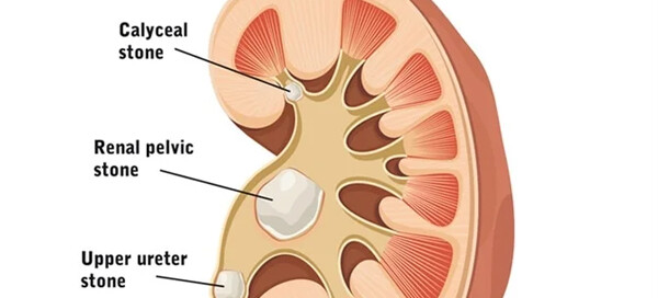 Nephrolithiasis - Prevention of Kidney Stones