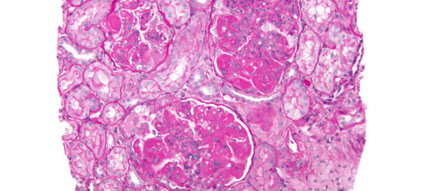 Lupus Nephritis