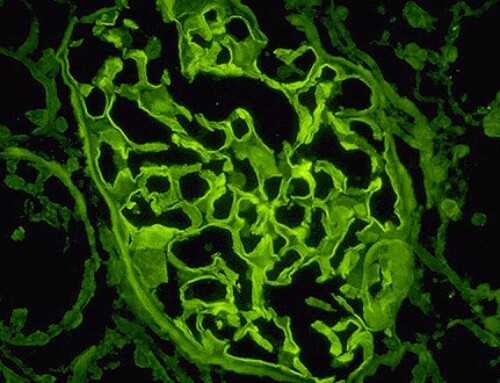 Anti Glomerular Basement Membrane Disease