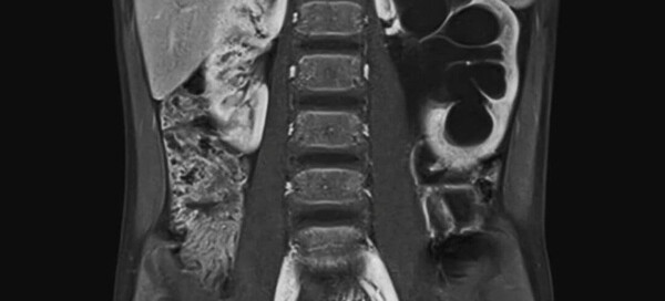 MRI Contrast and the Kidney