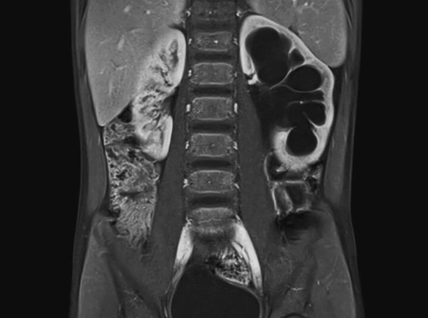 MRI Contrast and the Kidney