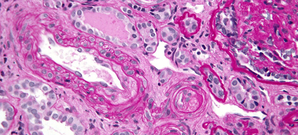 Thrombotic Microangiopathy