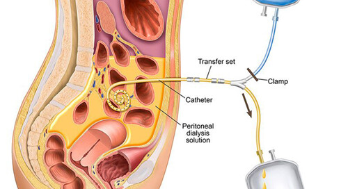 Peritoneal Dialysis
