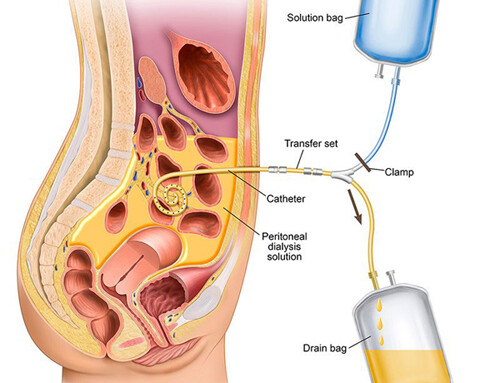 Overview of Peritoneal Dialysis