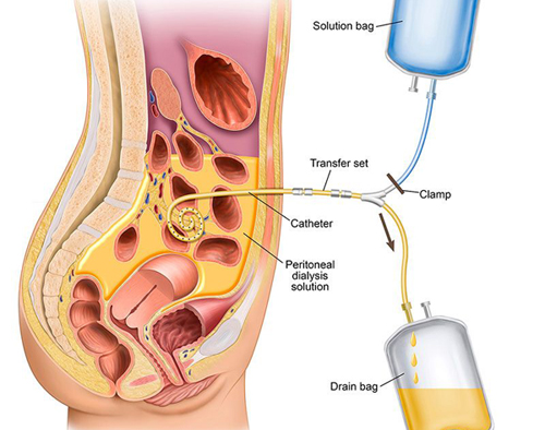 Peritoneal Dialysis