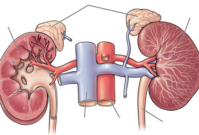 Primary Hyperaldosteronism
