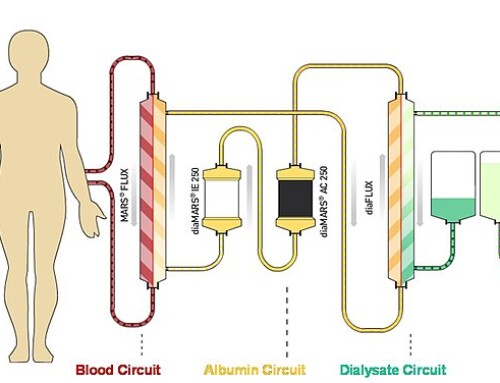 Dialysis for Liver Failure?